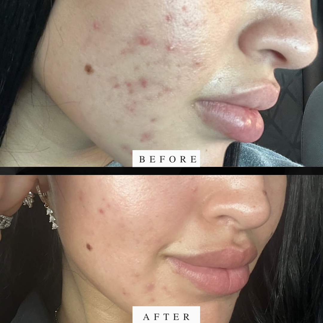 Pure Laurel Soap – For Acne & Sensitive Skin